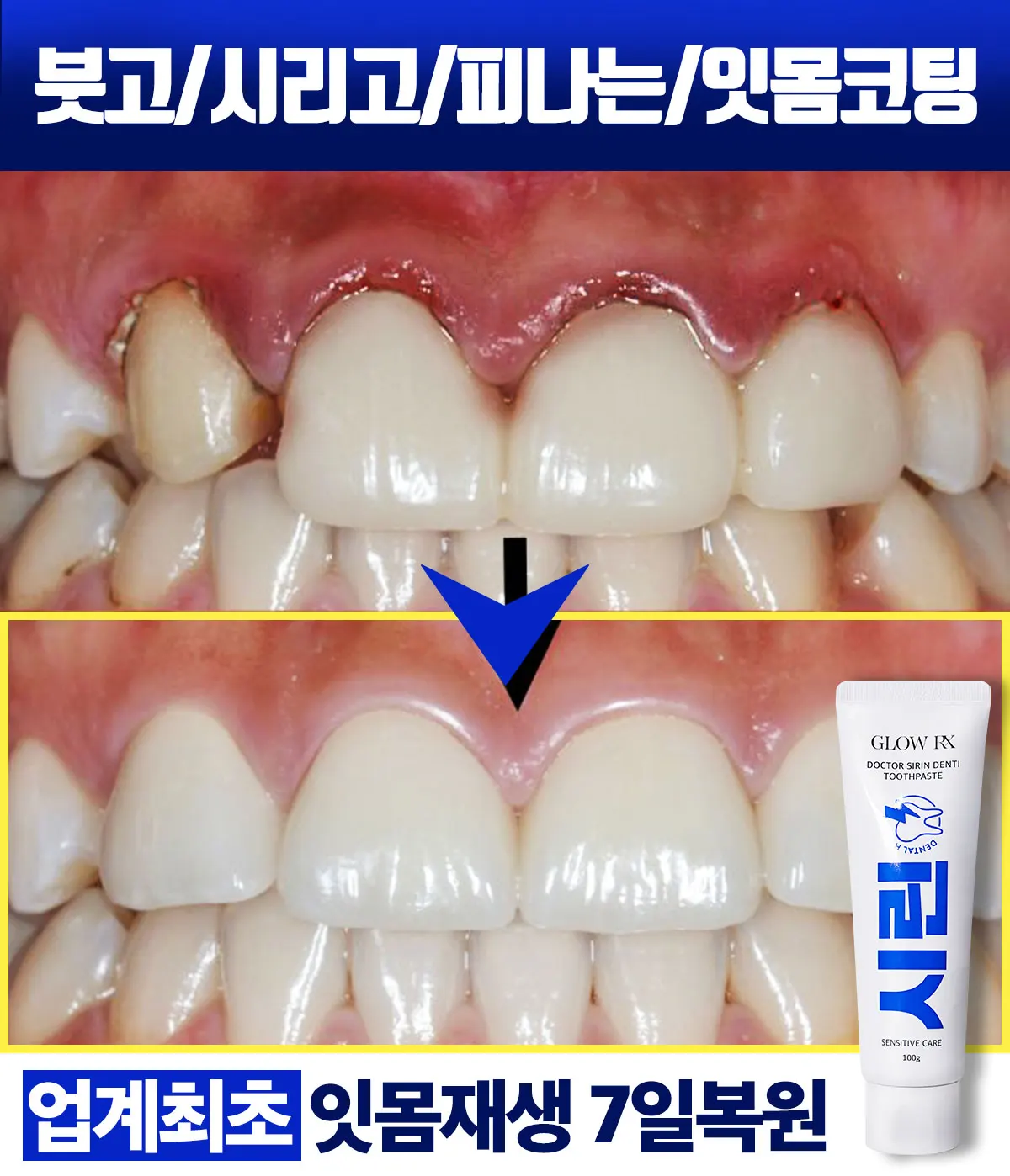 특가 한정판매 글로우알엑스 잇몸 볼륨 재생 잇몸 강화 구취 완화 시린 치아 개선 닥터 시린 덴티 치약