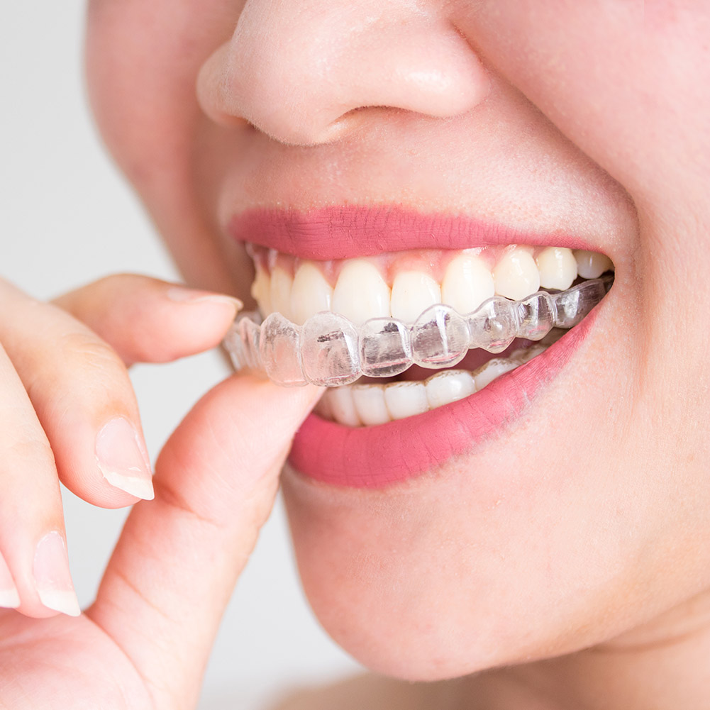 2-8PCS Anti Snoring Bruxism Sleeping Mouth GUARD ถาดหยุดฟัน Sleep Aid Night GUARD GUM SHIELD ปาก Health Care