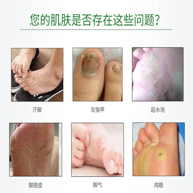 Semprotan Beri-beri Uniseks Cocok untuk Kaki Bau Kaki Kurap Kaki Gatal Kaki Busuk Kaki Hong Kong Semprotan Kaki Semangat