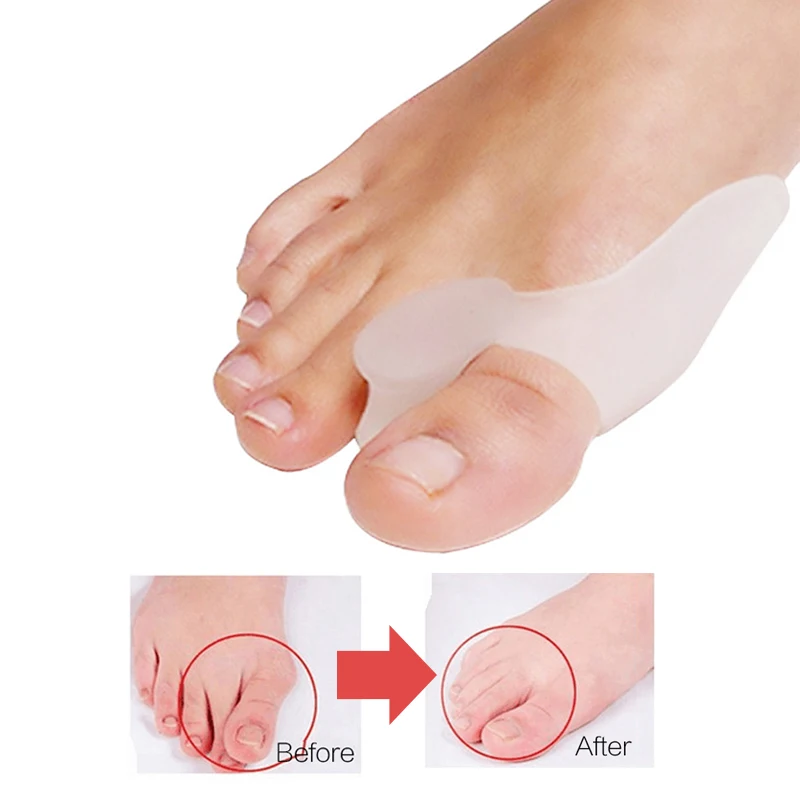 1 คู่ซิลิโคนนิ้วเท้าแยก Bunion Bone Ectropion Adjuster นิ้วเท้าด้านนอกอุปกรณ์เท้าเครื่องมือดูแล Hallux Valgus Corrector