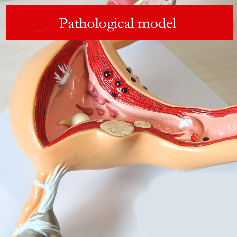 Medizinische Wissenschaft Normale/Pathologische Gebärmutter Eierstock Anatomisches Modell Anatomie Querschnitt Medizinisches Lehrmaterial
