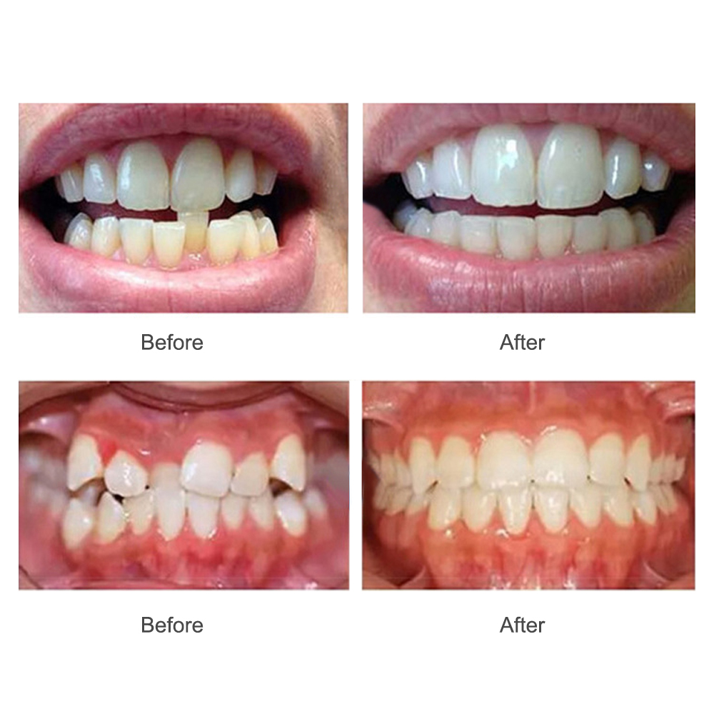 Aparatos de ortodoncia, aparatos dentales, entrenador de alineación de dientes con sonrisa, retenedor de dientes de silicona instantáneo, protector bucal, bandeja para dientes