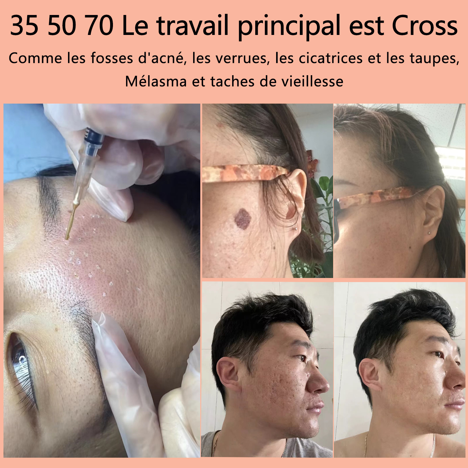 Tampons de Peeling Chimiques TCA, 75 Tampons en Boîte, 20 30 35 50 70 Ordinaires pour le Nettoyage du Visage et du Corps