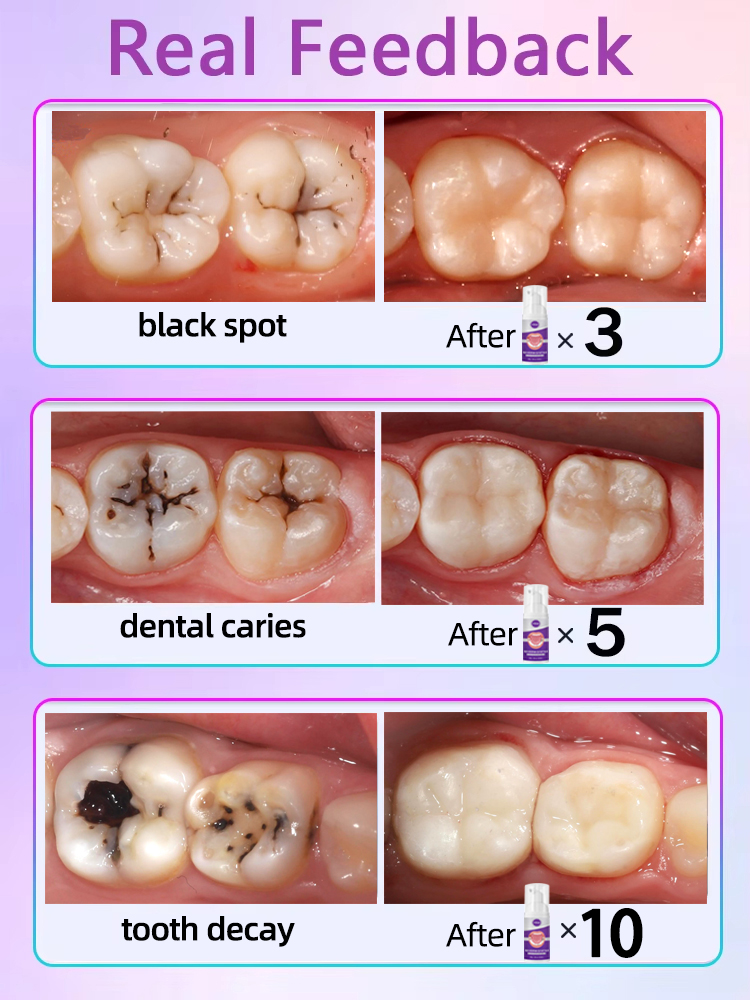 Reparación de caries dental Reparación de caries antiprotección de caries
