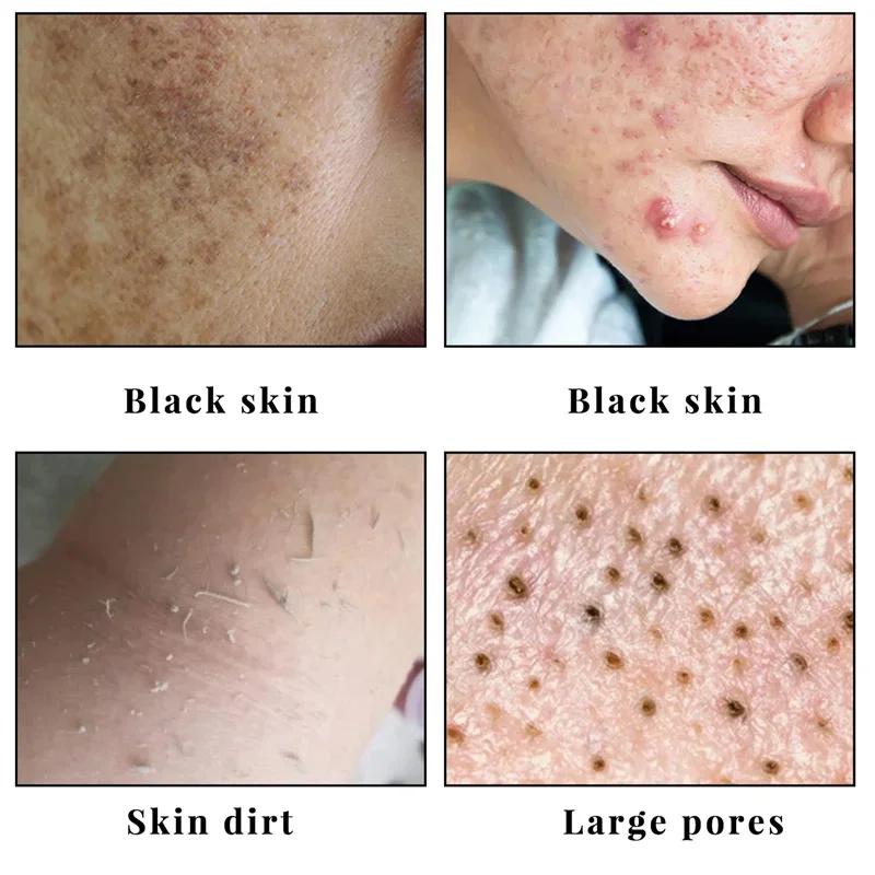 Sabonete branqueador corporal, sabonete branqueador para axilas e joelho, remoção de pele de frango, remoção de manchas escuras, hidratação da pele morta, iluminar, cuidados com o corpo