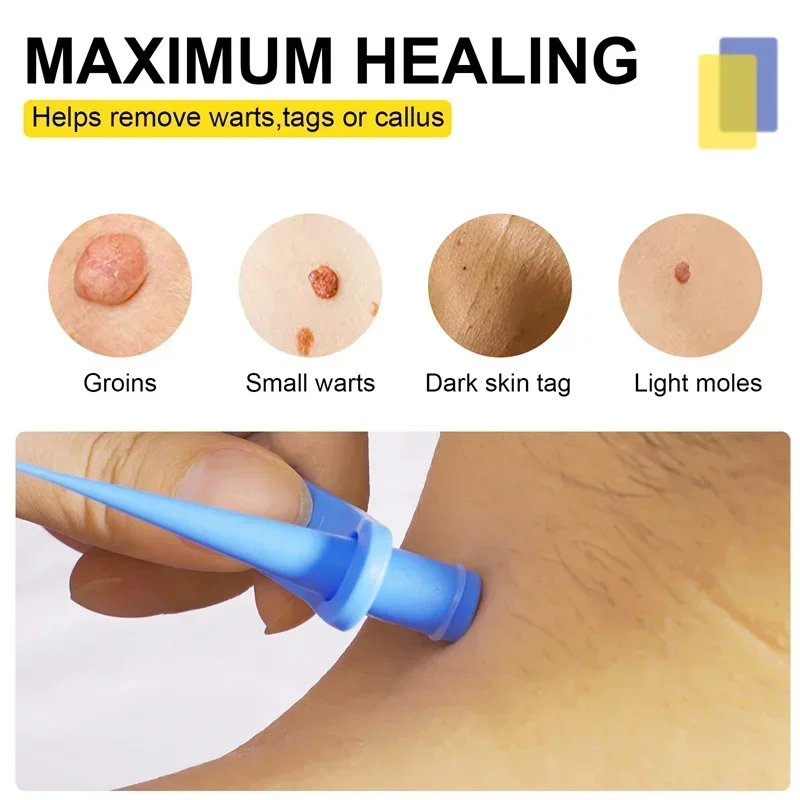 1 Set Skin Tag Removal Kit Skin Mole Wart Remover Micro Band Skin Tag Removal Kit Tag Treatment Tools Set with Cleansing Swabs