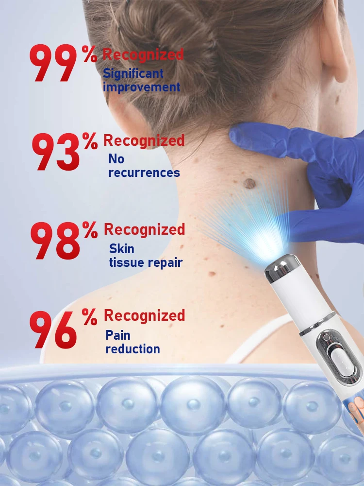 ᴸᵃˢᵉʳ ᵖᵉⁿ ᵃᶜᶜᵘʳᵃᵗᵉˡʸ ʳᵉᵐᵒᵛᵉˢ warts without scarring or recurrence