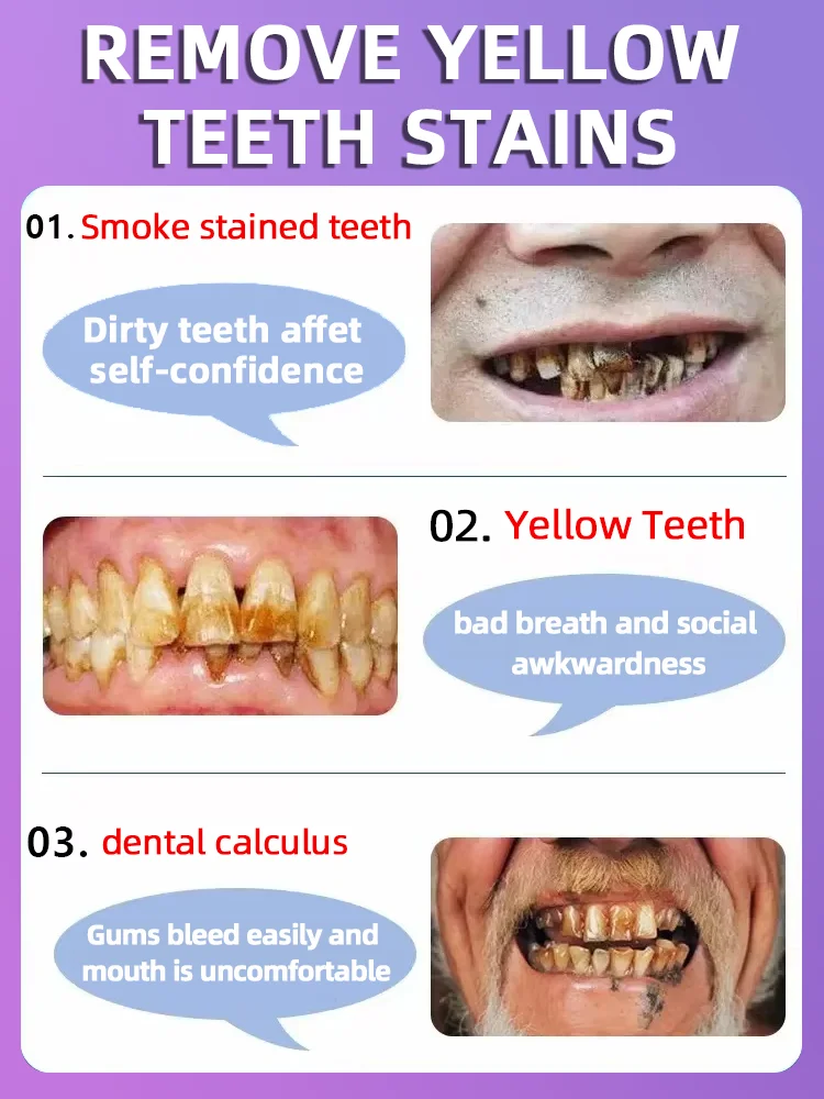 Reparación de caries dental Caries Caries Tratamiento anti-cías