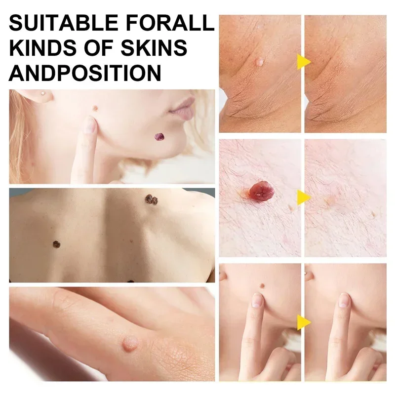 1 Set Skin Tag Removal Kit Skin Mole Wart Remover Micro Band Skin Tag Removal Kit Tag Treatment Tools Set with Cleansing Swabs