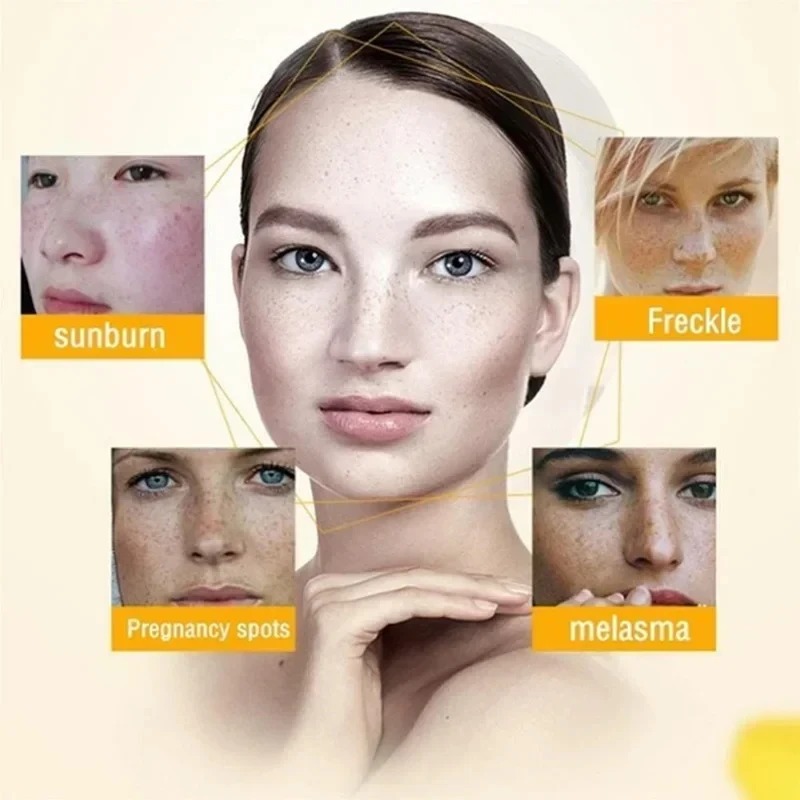 Whitening Freckle Cream Remove Dark Spots Anti Freckle Face Creams Niacinamide Fade Pigmentation Melasma Brighten Skin Care 20g
