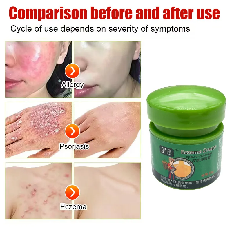 Tratamiento eczematoide para dermatitis, ungüento antibacteriano, crema para psoriasis a base de hierbas, producto eficaz para el cuidado de la piel, antipicazón corporal