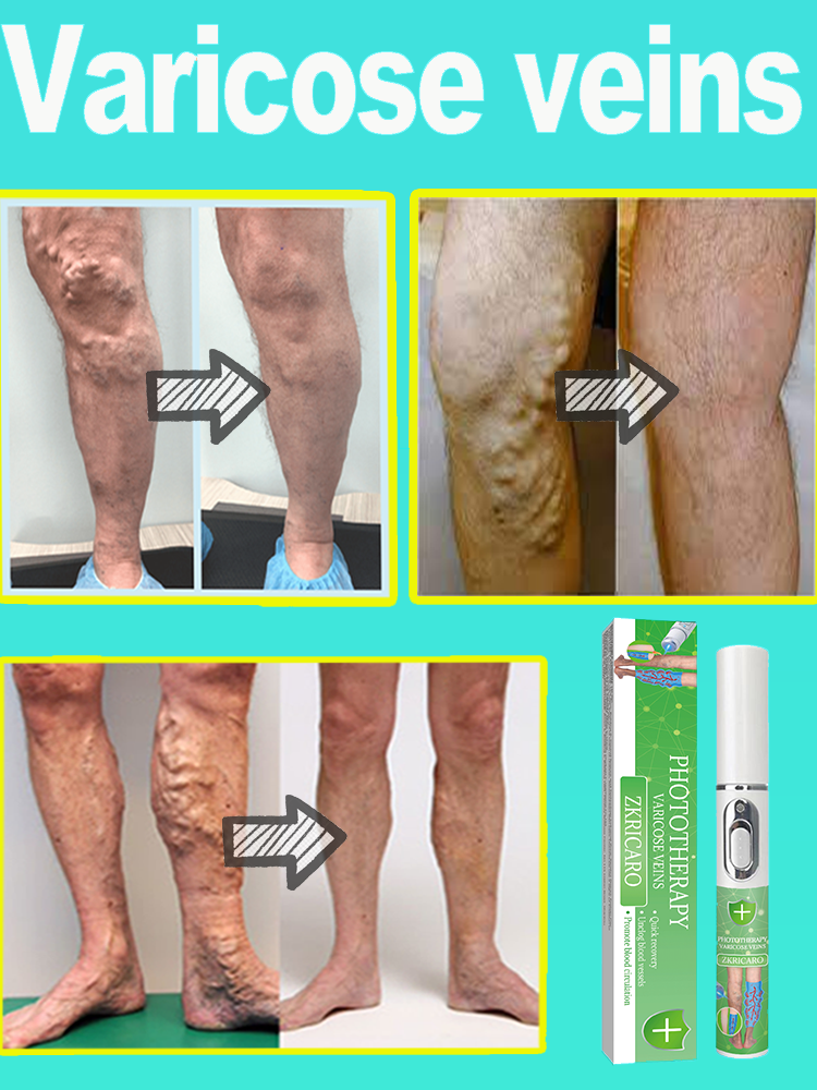 Hot Selling Laser Vein