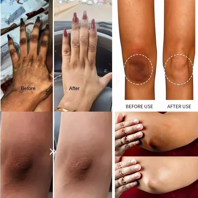 Crema blanqueadora rápida, iluminadora de piel oscura, axilas, muslos internos, codos, blanqueador de articulaciones, elimina la melanina