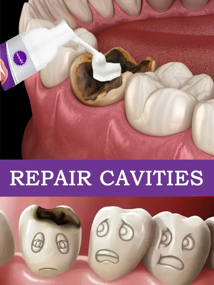 Tooth Decay Repair Decay Cavities Anti Caries Gum Treatment