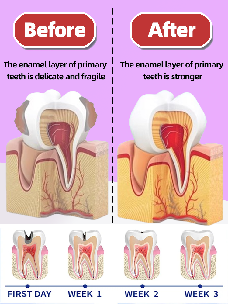 Reparación de caries dental Caries Caries Tratamiento anti-cías