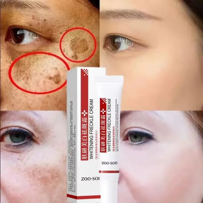 Creme clareador de remoção de manchas poderoso, clareia a pele, elimina rapidamente a pigmentação da melanina, manchas escuras do melasma, cuidados com a pele coreanos, 2024