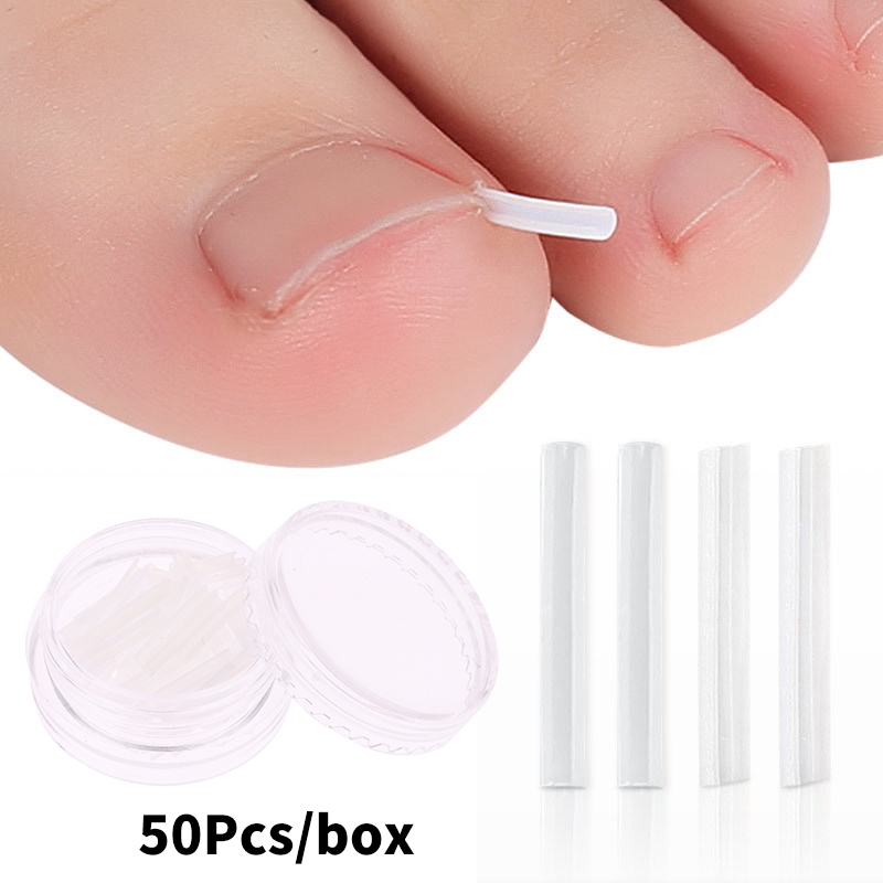 50 Pz/scatola Strisce di Correzione Unghia Incarnita Correzione Paronichia Raddrizzamento Brace Trattamento Delle Unghie Dei Piedi Scanalatura Strumenti di Pedicure