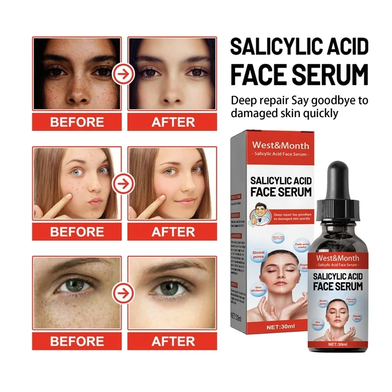 Nicotinamida que atenúa las manchas, esencia Facial, ácido salicílico, reduce los poros, eliminación de pecas, hidrata, productos para el cuidado de la piel 2024