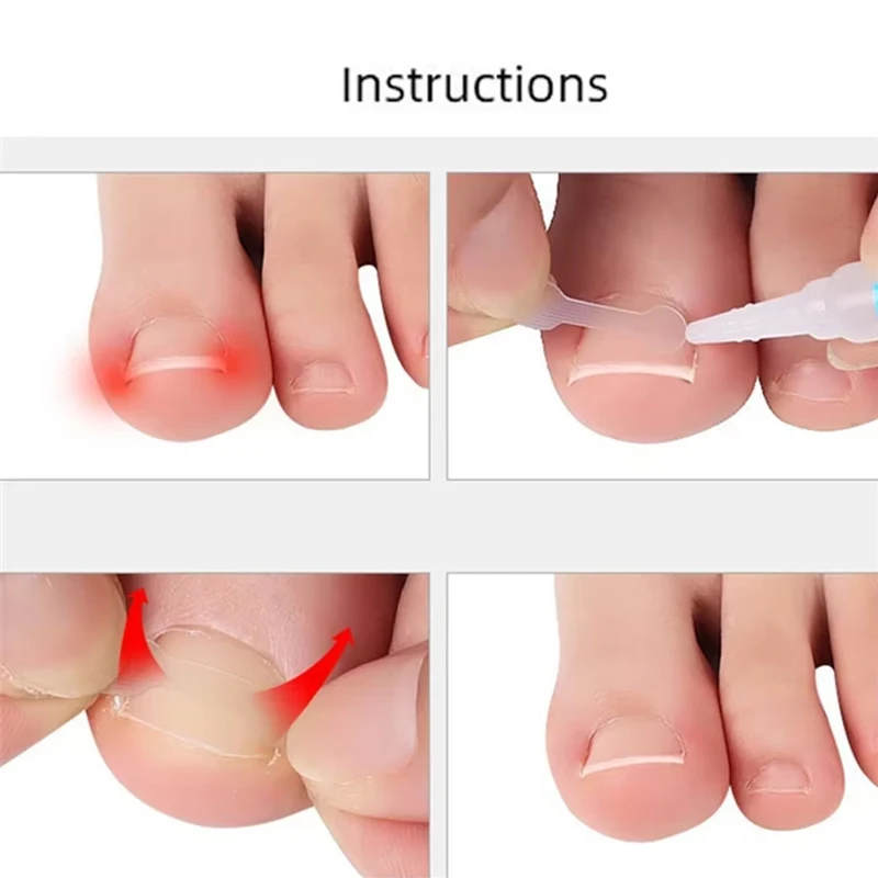 10PCS Ingrown Toe Nail Treatment Ingrown Toenail Correction Tool Elastic Patch Sticker Straightening Clip Brace Pedicure Tools