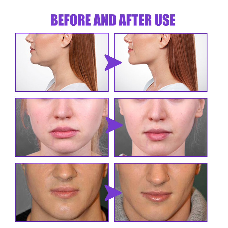 V-Shape Firming Face-Lift ครีมกระชับสัดส่วนกําจัด Masseter กล้ามเนื้อ Double Chin Face FAT Burning Anti-Aging ผลิตภัณฑ์ใหม่
