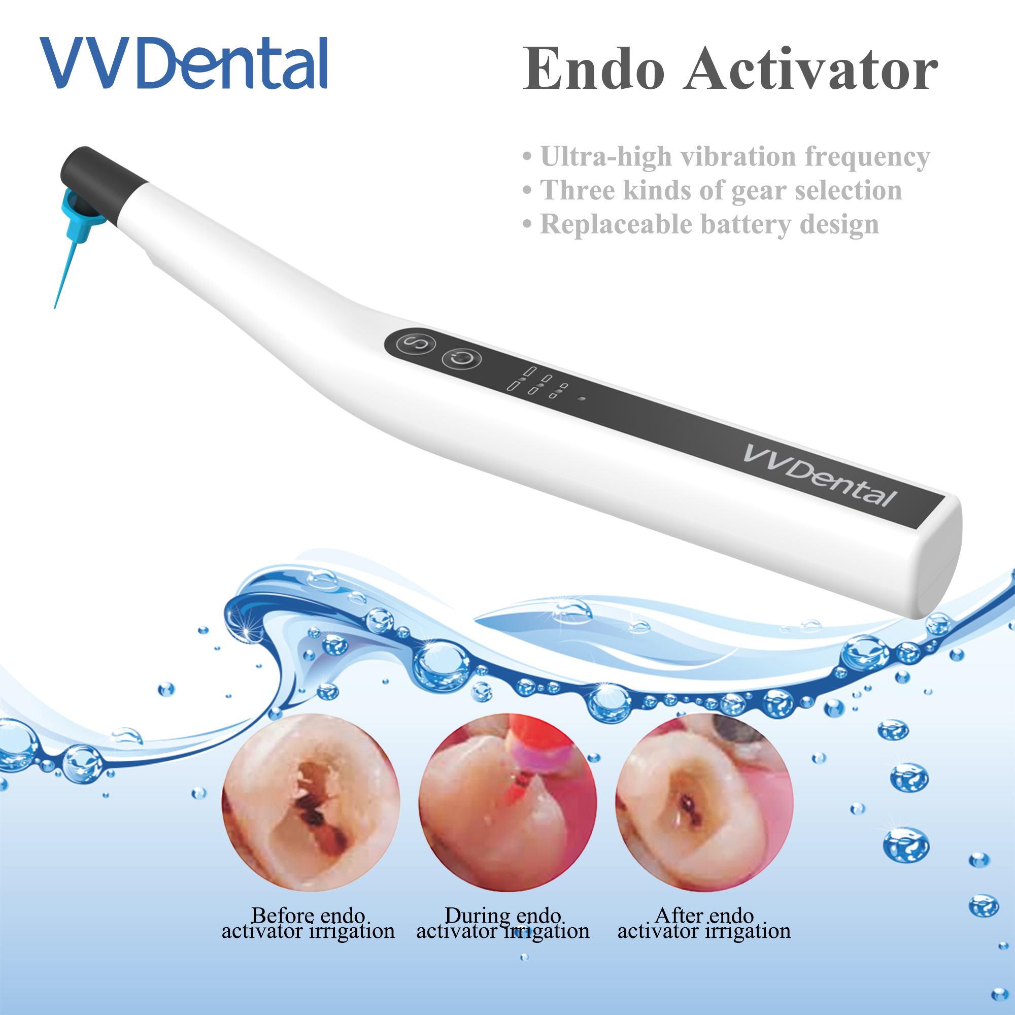 VVDental Sonic Irrigator เคล็ดลับ Endo Activator พร้อมไฟ LED สําหรับเครื่องมือทันตกรรม Root Canal Sonic Irrigator Endodontic เครื่องมือ