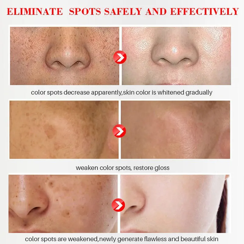 Whitening Freckle Cream Melasma Pigmentation Remove Nicotinamide Serum Cream Pores Refining Black Spot Acne Marks Removal Cream