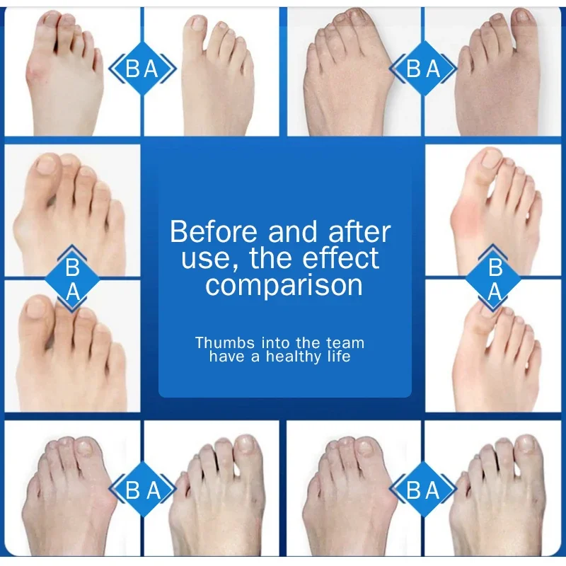 1 par dedo do pé joanete tala alisador corrector pé para osso grande hálux valgus pés cuidados protetor alívio da dor ferramentas de cuidados com os pés