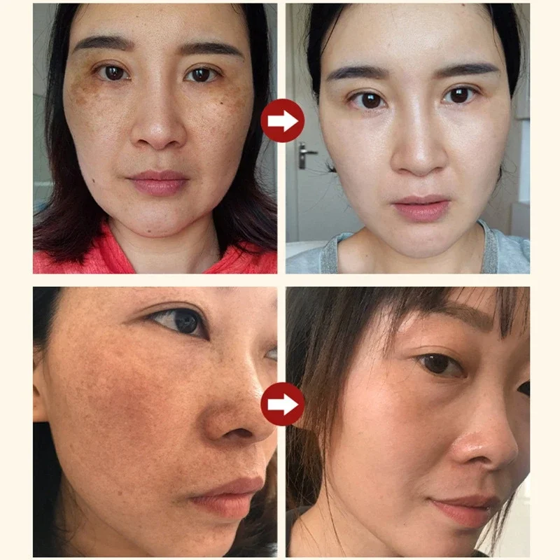 Nicotinamida que atenúa las manchas, esencia Facial, ácido salicílico, reduce los poros, eliminación de pecas, hidrata, productos para el cuidado de la piel 2024