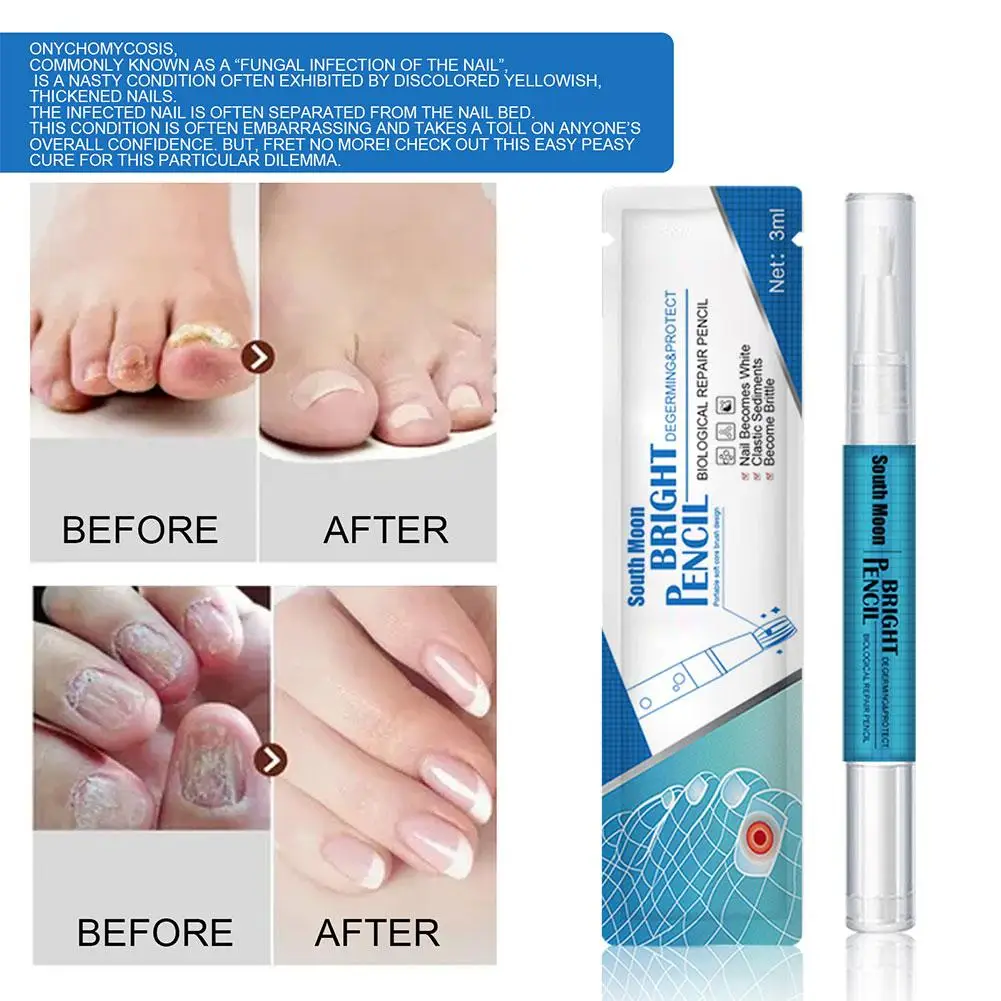 Pluma líquida para reparación de uñas, suero para tratamiento de hongos en las uñas, crema para los dedos de los pies, Gel antieliminación, reparación de hongos en los pies, infección líquida F4I6, 3 ML