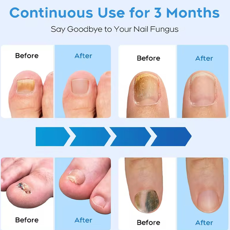 KTS półłukowe urządzenie laserowe do grzybicy paznokci 12x470nm 6x910nm leczenie grzybicy paznokci paznokci u stóp terapia grzybicza paznokci wyświetlacz czasu 2000mA