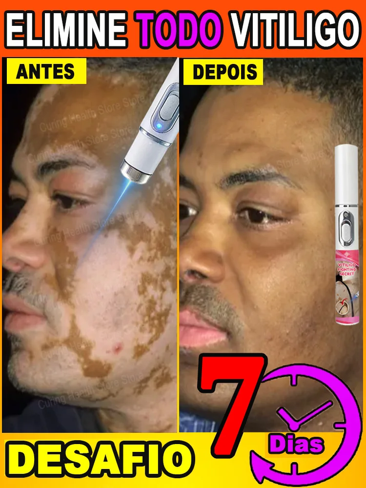 Laser vitiligo laser