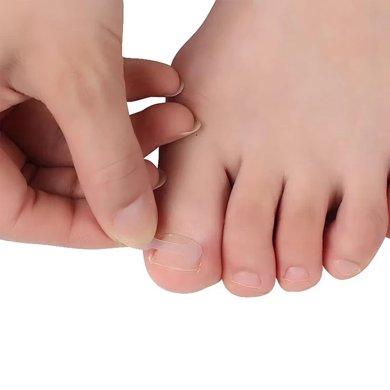 10PCS Ingrown Toe Nail Treatment Ingrown Toenail Correction Tool Elastic Patch Sticker Straightening Clip Brace Pedicure Tools