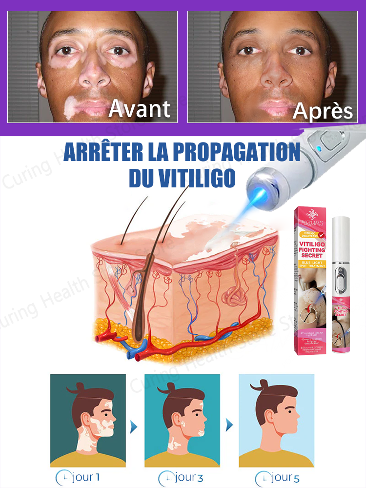 Laser vitiligo