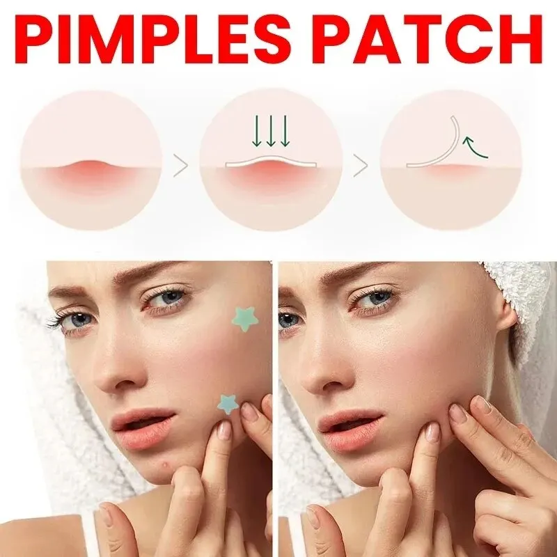 Parche de reparación de acné para el cuidado de la piel Facial, manchas, marcas de granos, manchas de acné cerradas, cubierta de granos de acné