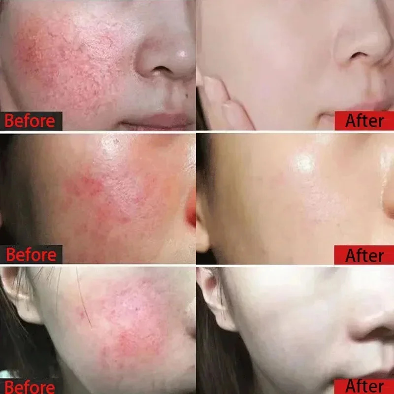 Crema reparadora de enrojecimiento Facial mejora la sequedad de la piel sensible crema hidratante loción calmante eliminación Rosacea Cosméticos Coreanos