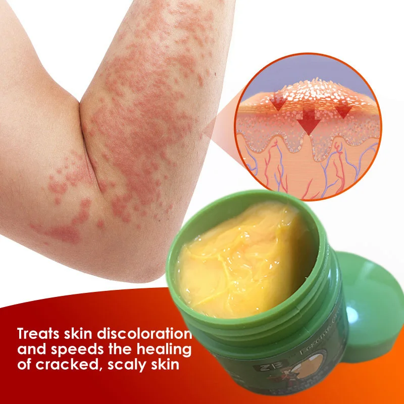 Tratamiento eczematoide para dermatitis, ungüento antibacteriano, crema para psoriasis a base de hierbas, producto eficaz para el cuidado de la piel, antipicazón corporal