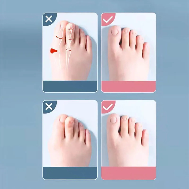 Separador de dedos de silicona, esparcidor de dedos, Hallux Valgus, Corrector de juanete, alisador de dedos, separadores de dedos, 2 uds.