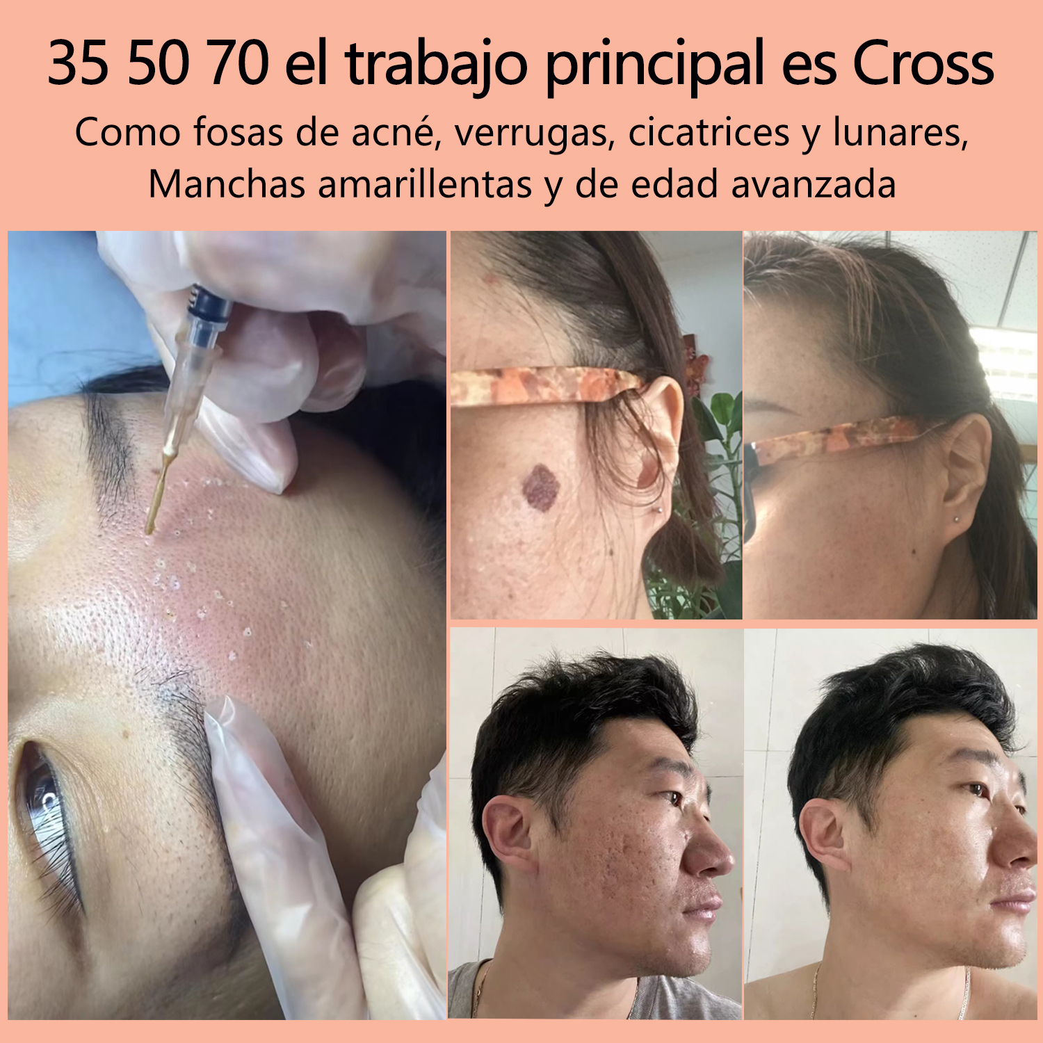 TCA, almohadillas peladoras TCA, almohadillas peladoras químicas Tca, 75 almohadillas en caja, 20 30 35 50 70 ordinario para limpieza facial y corporal, cruz,