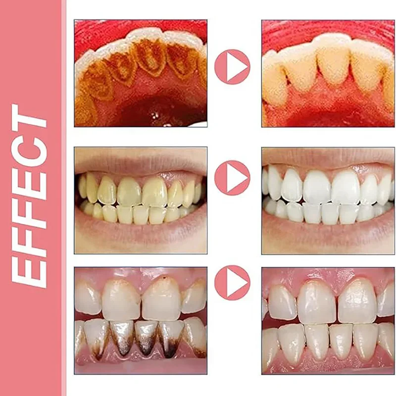 SP-10 ยาสีฟันโปรไบโอติกขจัดคราบจุลินทรีย์ฟันขาวสุขอนามัยช่องปากทําความสะอาดลมหายใจสดชื่นผลิตภัณฑ์ดูแลฟันใหม่