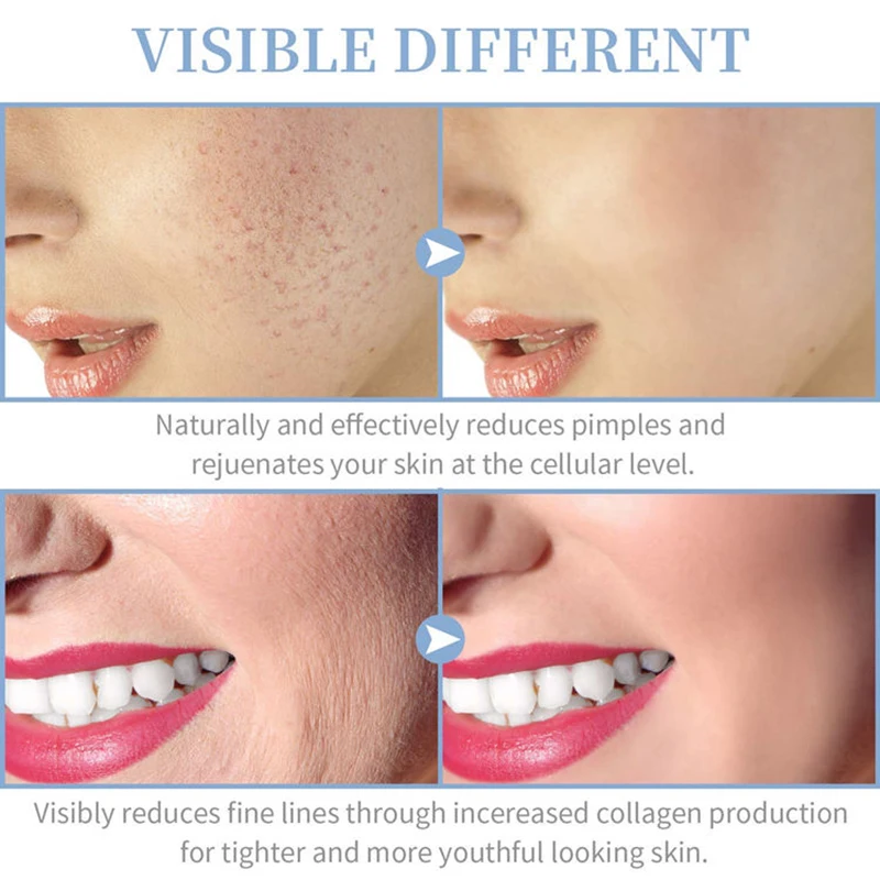 ความถี่สูง Skin Therapy Wand เครื่องแบบพกพาสําหรับนวดสิวฟื้นฟูผิวกระชับลดริ้วรอยเครื่องมือ