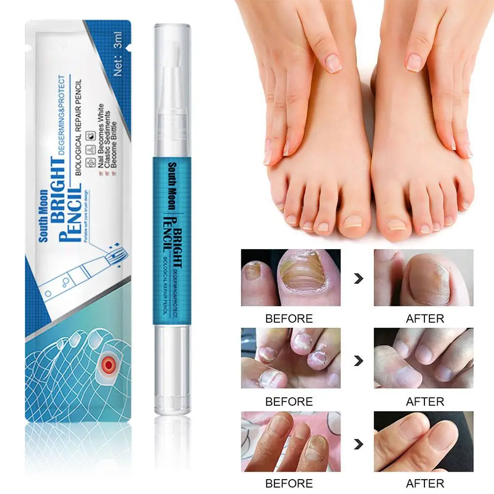 Pluma líquida para reparación de uñas, suero para tratamiento de hongos en las uñas, crema para los dedos de los pies, Gel antieliminación, reparación de hongos en los pies, infección líquida F4I6, 3 ML