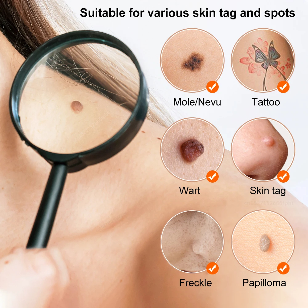 19 Gears เครื่องมือความงาม Freckle Removal ปากกา Skin Mole Removal Dark Spot Remover สําหรับ Face Wart Tag Tattoo Remover ปากกา