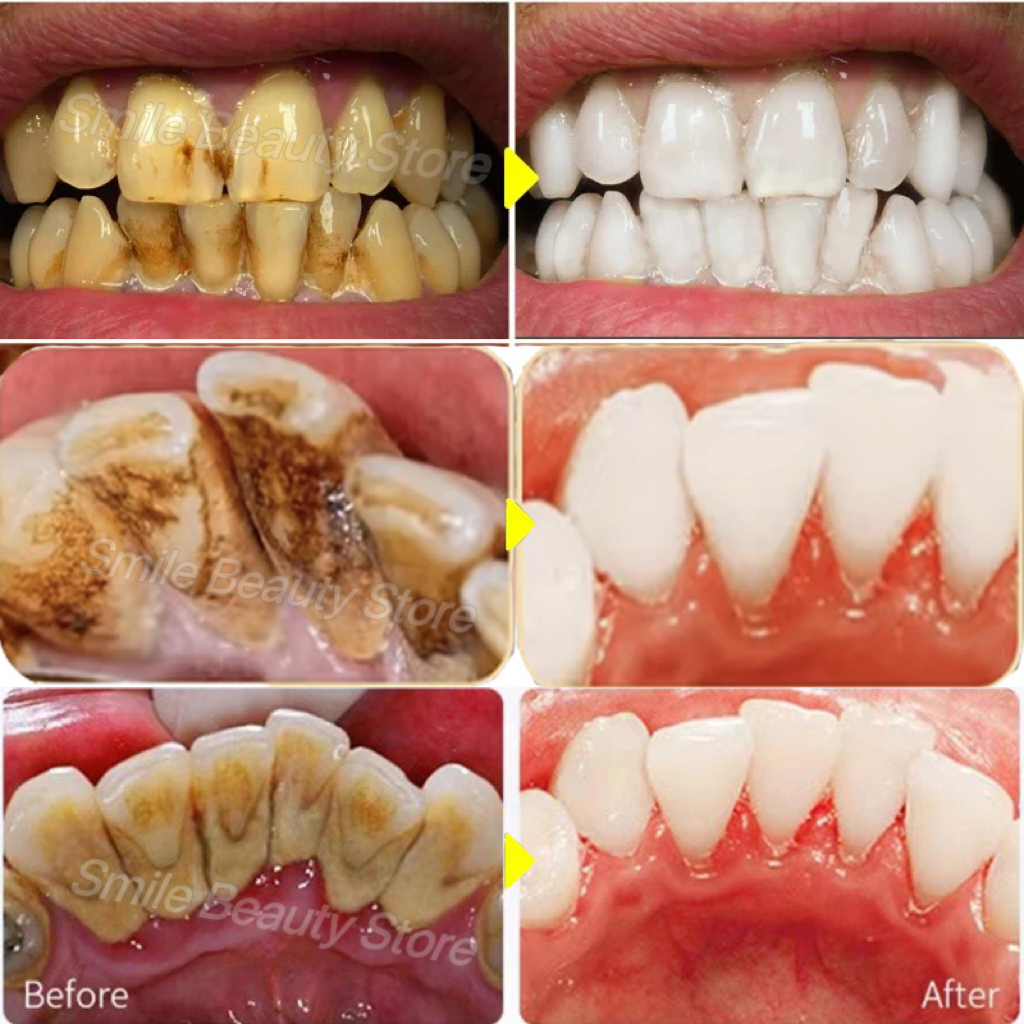Removedor de cálculo Dental, blanqueamiento Dental en aerosol, pasta de dientes, limpieza, higiene bucal, eliminación de halitosis, manchas de placa, cuidado del aliento fresco