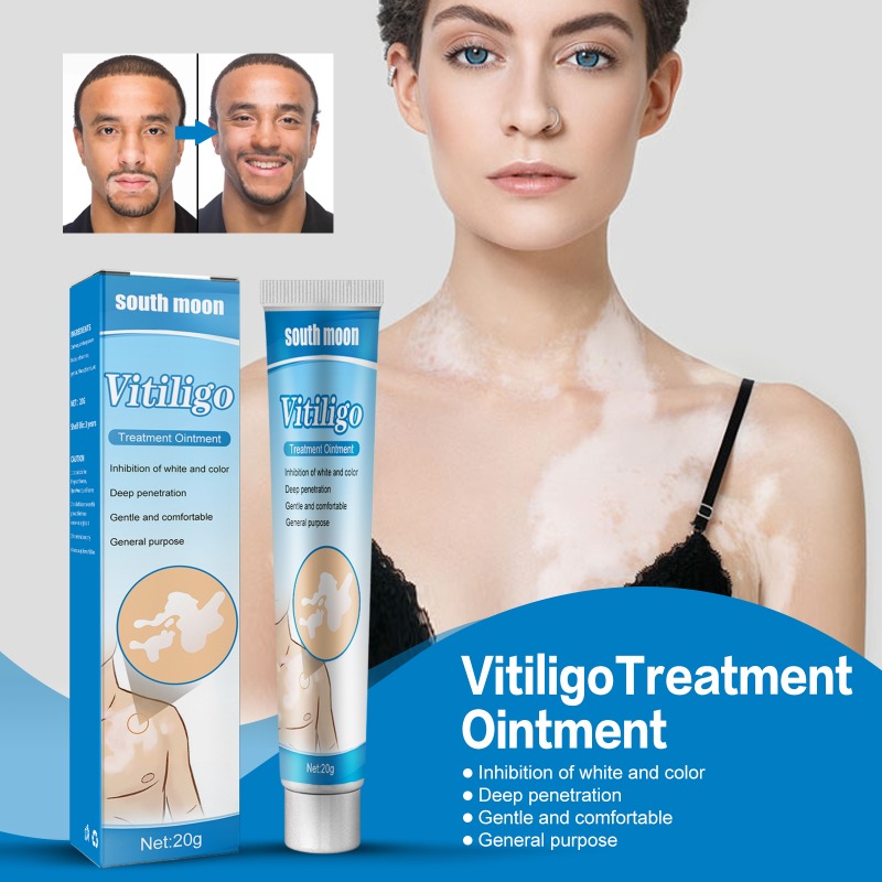 Crema de eliminación de Vitiligo, pomada calmante Natural para manchas blancas, cuidado de la salud, 20g