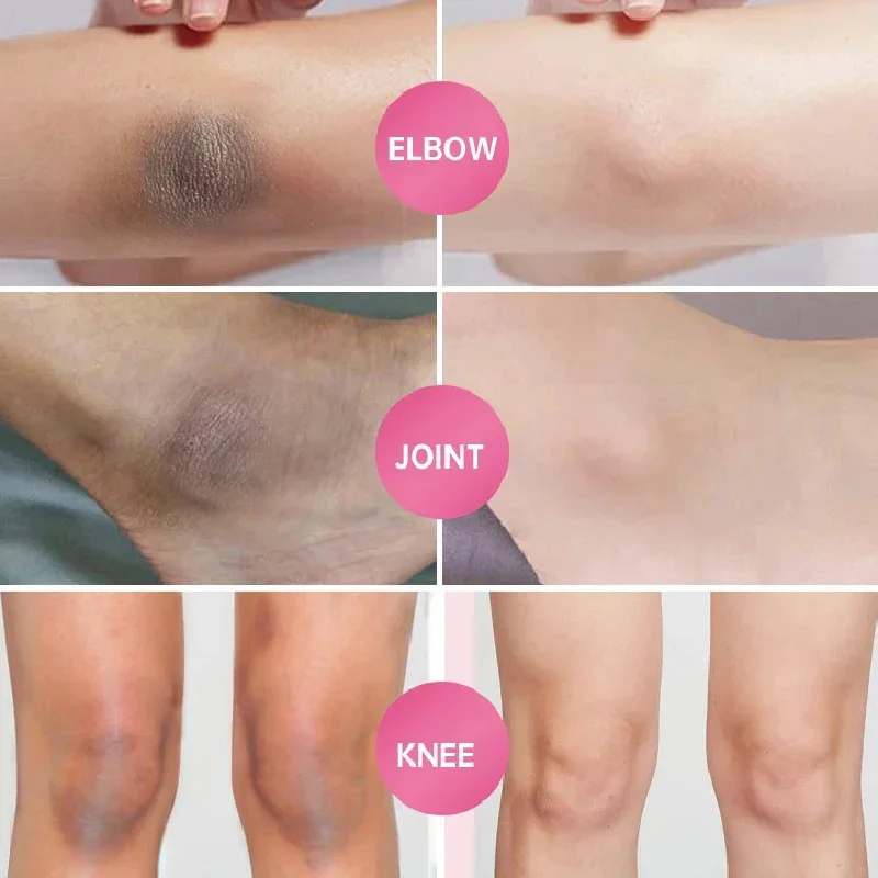  Sakura-crema blanqueadora para partes privadas, suero blanqueador para axilas, blanqueador de glúteos y rodillas, ilumina la parte interior del muslo, partes íntimas, eliminación oscura