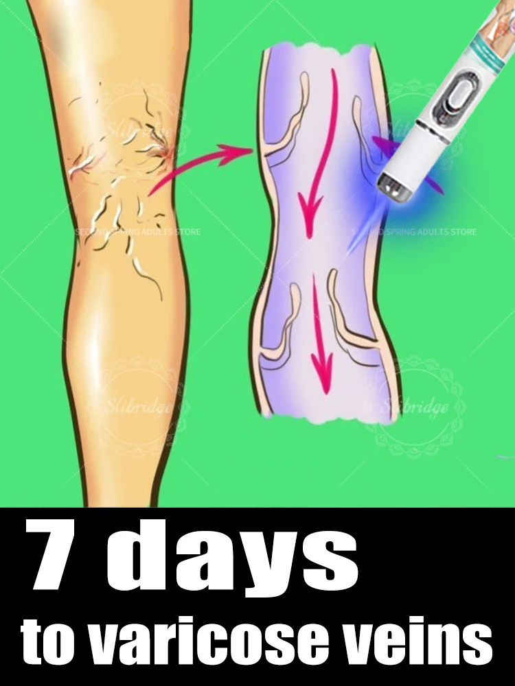 Leg care tools Reduce Uncomfortable For Legs Improving Blood Circulation Varicose Veins Pen Skin Care Product
