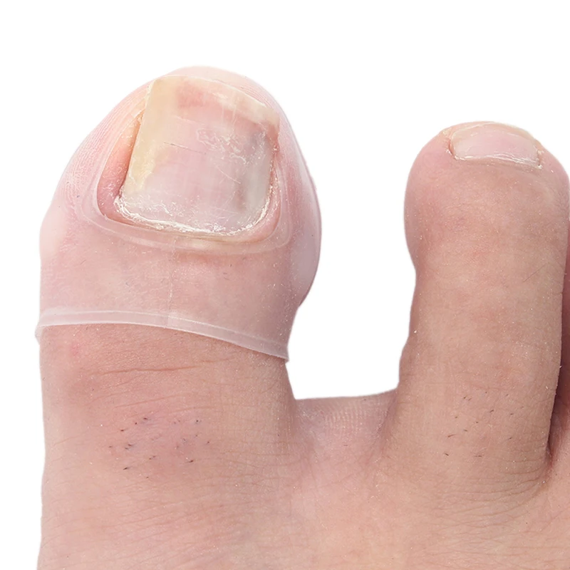Herramienta de corrección de uñas encarnadas de silicona, Invisible, tratamiento de uñas encarnadas, Clip de alisado elástico, Brace, herramienta de pedicura, 2 piezas
