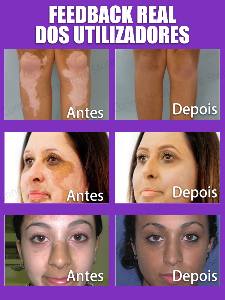 vitiligo laser