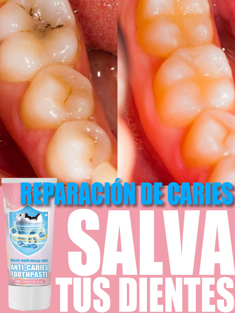 Pasta de dientes anticaries remineralización dental recuperación esmalte reparación fortalecimiento restauración caries protección dental dientes