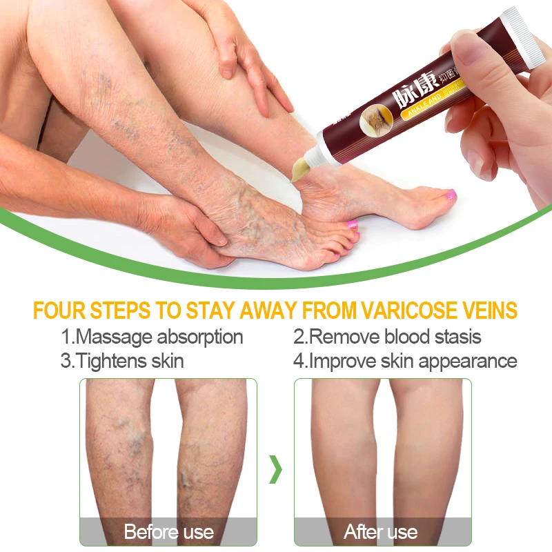 1 Chiếc Suy Giãn Tĩnh Mạch Điều Trị Kem Loại Bỏ Hồng Vệt Giãn Tĩnh Mạch Thừng Tinh Viêm Mạch Phlebitis Tăng Cường Mao Mạch Sức Khỏe S034